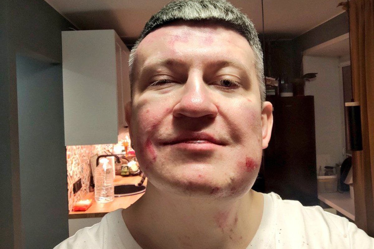 Синяки на лице Владимира после инцидента в клубе Mono. Фото: telegram-канал Болоболова